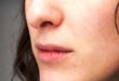 Cara Mengatasi Bibir Pecah pecah dengan Mudah yang Perlu Anda Ketahui