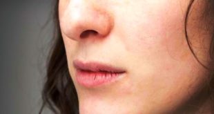 Cara Mengatasi Bibir Pecah pecah dengan Mudah yang Perlu Anda Ketahui