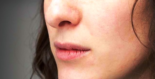 Cara Mengatasi Bibir Pecah pecah dengan Mudah yang Perlu Anda Ketahui
