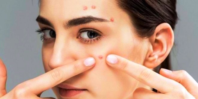 Cara Mudah Menghilangkan Jerawat secara Alami agar Wajah Bersih